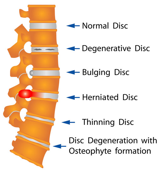 Illustration of common spine conditions.